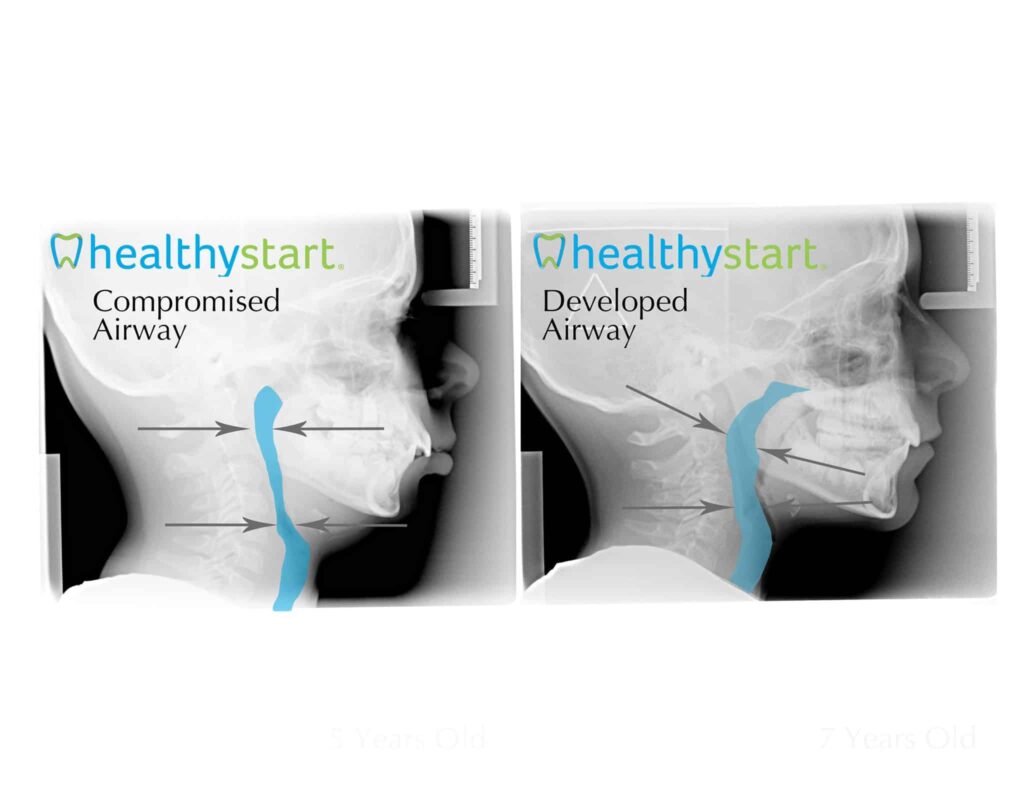 Compromised vs. Developed Airway